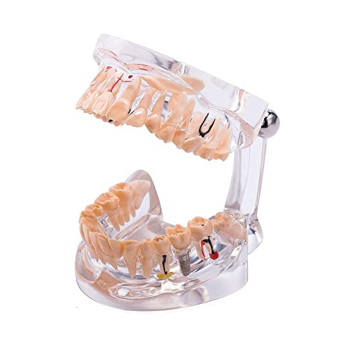 Model zubnih prozirnih zuba, model implantata za implantaciju bolesti uklonjivi standardni patološka demonstracija zuba