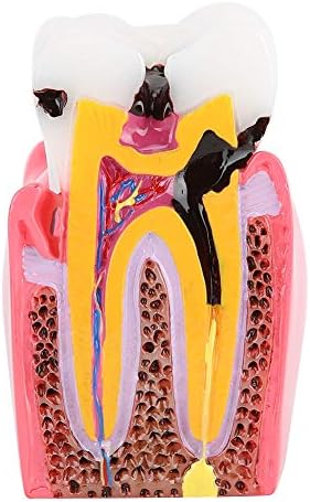 Zubni karijes zubi model karijesa usporedba studija studija modeli stomatološki stomatološka anatomija eon zubi model